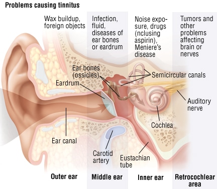 causes tinnitus