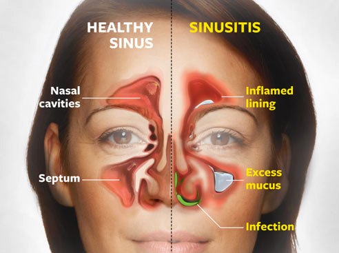 how to prevent constant sinus infections 60c8a90640fe2