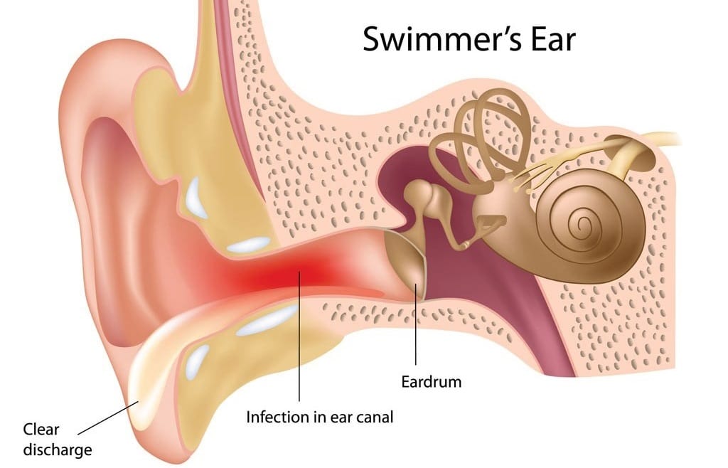 swimmers ear treatment