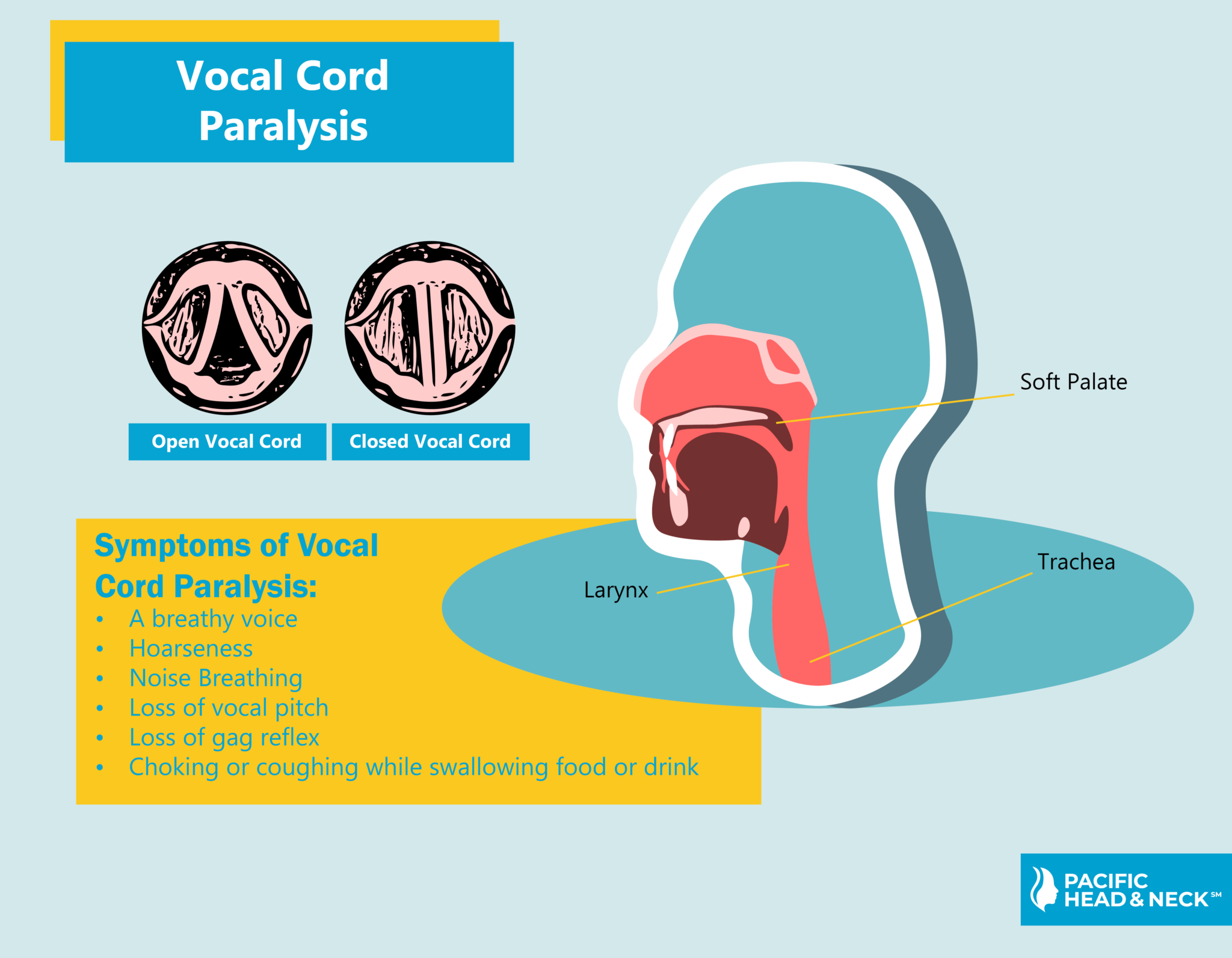 Vocal Cord Paralysis Pacific Head & Neck