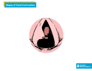 Infographic Biopsy of Vocal Cord Lesions No Web 1