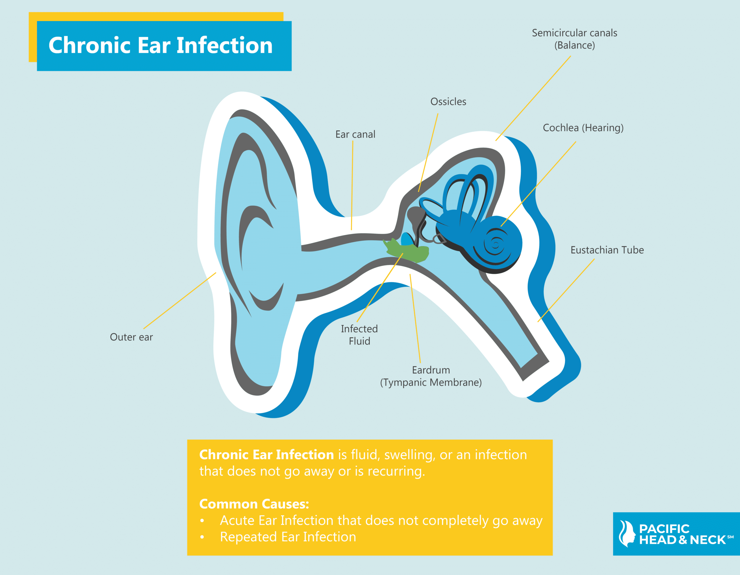 Infographic Chronic Ear Infection No Wen
