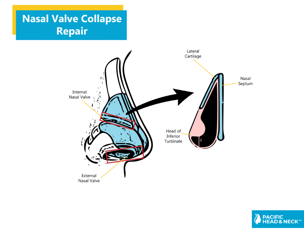 Nasal Valve Collapse Repair Pacific Eye & Ear Specialists