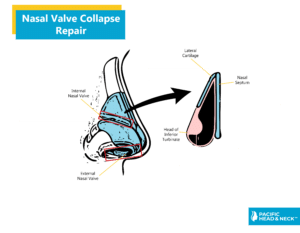 Infographic Nasal Valve Collapse Repair No Web 1