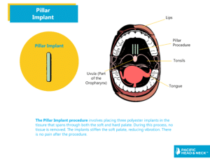 Infographic Pillar Implant No Web