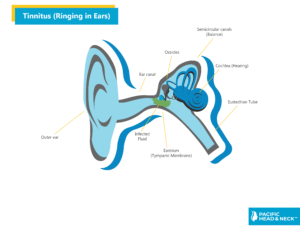 Infographic Tinnitus
