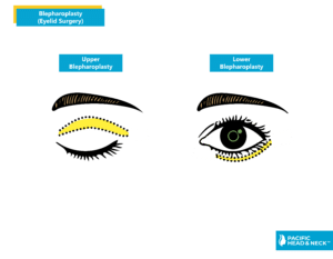 Infographic Blepharoplasty Eyelid Surgery