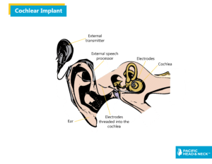 Infographic Cochlear Implant