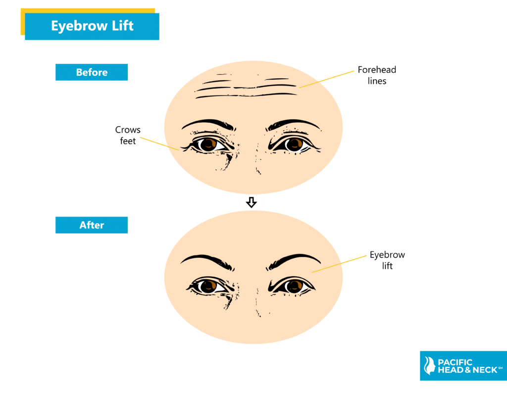 Eyebrow Lift Pacific Head and Neck
