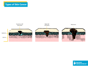 Infographic Types of skin caner